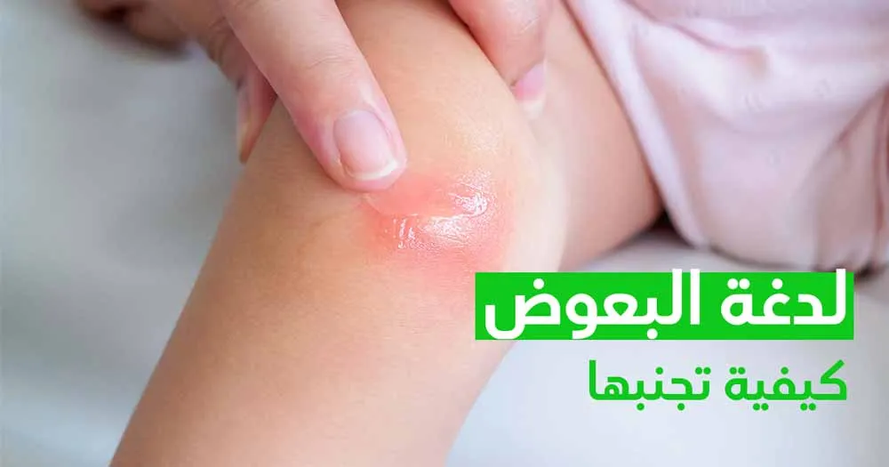 لدغة البعوض كيفية تجنبها